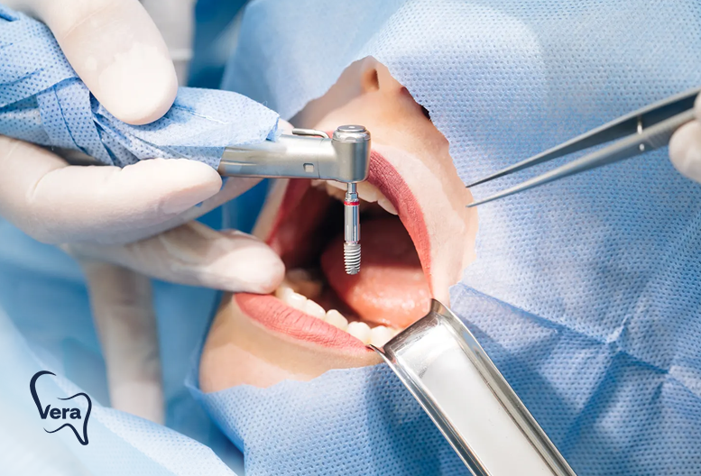 implant-tedavisi-vera-dent