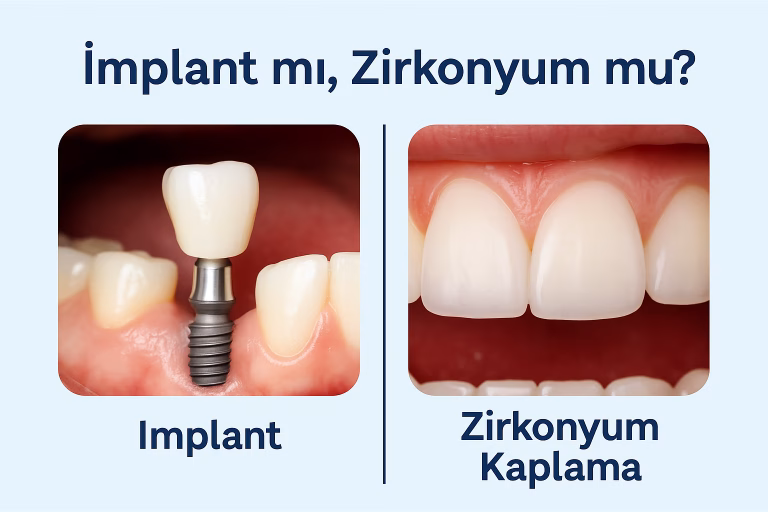 implant ve zirkonyum karşılaştırılması yapılan bir görsel